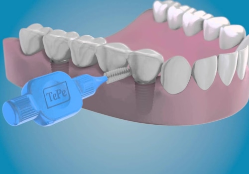 Caring for Teeth with Dental Implants: A Guide to Oral Hygiene