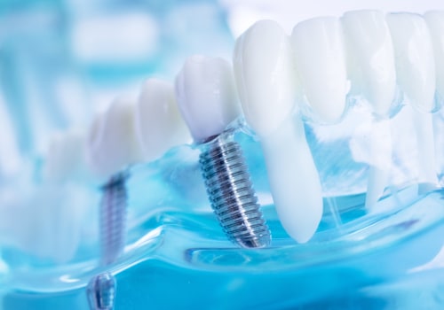 Caring for Dental Implants: A Comprehensive Guide