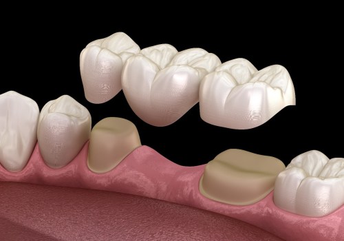 The Pros and Cons of Dental Bridges: A Comprehensive Guide