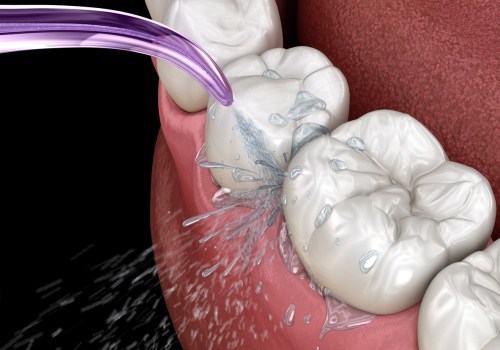 How to Keep Your Teeth Implants Clean and Healthy: A Guide for Oral Hygiene