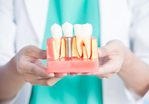 Everything You Need to Know About Dental Implants
