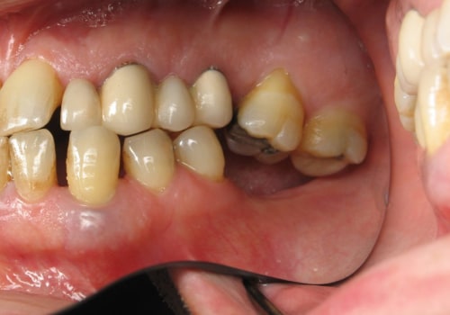 The Benefits of Dental Implants: Why You Shouldn't Wait to Get Them
