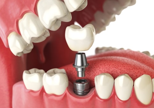 Can I Get a Dental Implant After Radiation Therapy to My Jaw?