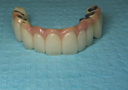 Which Option is Best for Replacing Missing Teeth: Dental Implants or Bridges?